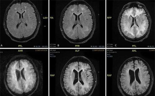 Cocaine có tác động khủng khiếp trên não như thế nào?