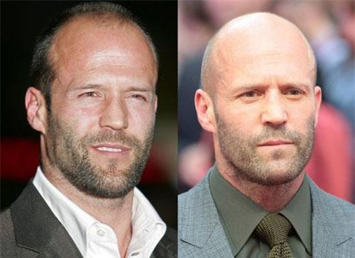 Những nam diễn viên đẹp trai hơn với kiểu “đầu trọc”