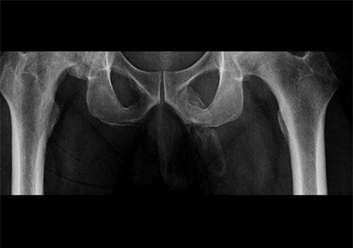 Bệnh nhân kì lạ có "cậu nhỏ" đang biến thành xương