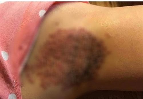 Rùng mình với hình ảnh "đốt ổ hôi nách" lan truyền trên mạng xã hội, nhìn thôi cũng thấy đau nhưng nhiều chị em vẫn cắn răng làm