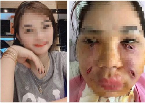 Tránh phải rạch mặt nặn mủ, chuyên gia khuyến cáo 5 điều quan trọng khi tiêm mỡ tự thân