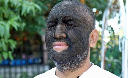 “Người sói” nhiều lông nhất thế giới tự tin khoe sự khác biệt