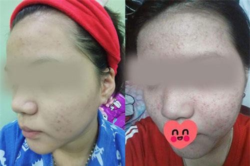 Dùng rượu thuốc bán tràn lan trên mạng để trị mụn, tái tạo da nhiều chị em rước họa "nát mặt"