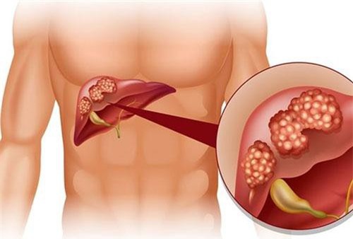 Bài thuốc với nguyên liệu chưa đến 10 nghìn đồng giúp thải sạch bong mọi độc tố trong lá gan hiệu quả