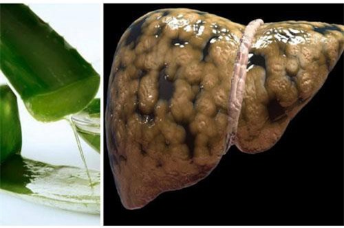 Gan nhiễm mỡ mấy năm cũng khỏi tiệt nhờ áp dụng bài thuốc rẻ tiền từ cây nha đam theo cách này