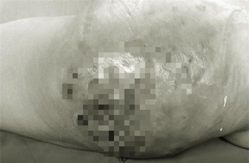 Người phụ nữ bị hoại tử mông nặng do đi phẫu thuật thẩm mỹ