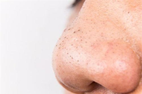 Mội lần rửa mặt làm điều này trong 30 giây cả đời sẽ không bị lại mụn đầu đen