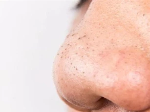 Mội lần rửa mặt làm điều này trong 30 giây cả đời sẽ không bị lại mụn đầu đen