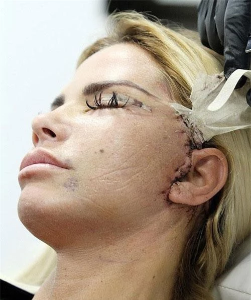 Hình ảnh Katie Price với vết khâu trong lần phẫu thuật thẩm mỹ mới nhất.
