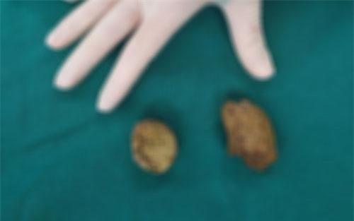 Khoái ăn măng, hồng ngâm và sung, bé gái phải nhập viện vì tắc ruột