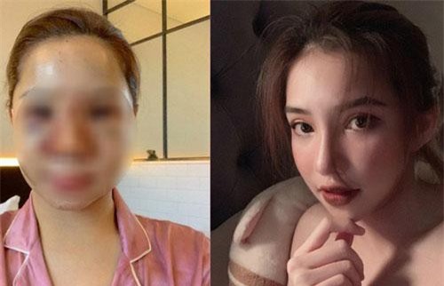 Lưu Đê Ly công khai quá trình phẫu thuật thẩm mỹ, diện mạo sau 2 tháng gây bất ngờ