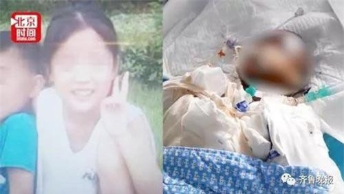 Bắt chước "thánh nữ văn phòng" Tiểu Dã làm bỏng ngô tại nhà, bé gái 14 tuổi gặp tai nạn bỏng nặng rồi tử vong sau hơn 1 tuần