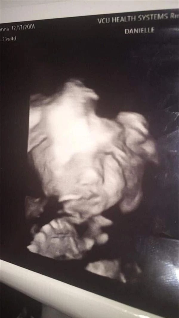 Đi siêu âm thai nhi 24 tuần tuổi, bà mẹ hết hồn khi thấy hình ảnh bé con như đang nhìn chằm chằm mình-2