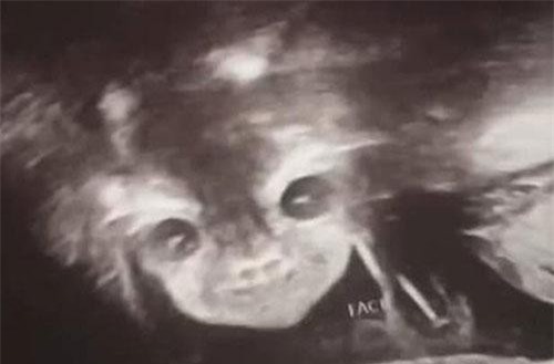 Đi siêu âm thai nhi 24 tuần tuổi, bà mẹ hết hồn khi thấy hình ảnh bé con như đang nhìn chằm chằm mình