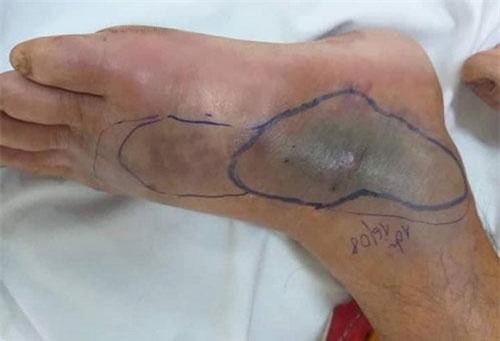 Hà Tĩnh: Đi bộ trên đường, bị rắn độc cắn hoại tử chân