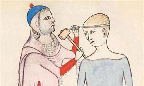 Hãi hùng kỹ thuật khoan hộp sọ của người cổ đại