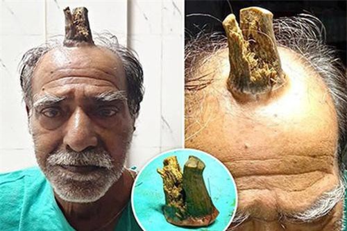 Cứ nghĩ khối u trên đầu vô hại, người đàn ông chẳng ngờ sau 5 năm nó hóa "sừng quỷ" dài 10cm làm ai nhìn vào cũng thấy sợ