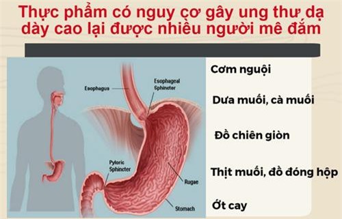 Thực phẩm gây ung thư dạ dày cao lại được nhiều người mê đắm
