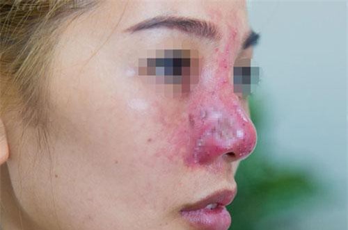Cô gái suýt mất mũi vì tiêm filler giá rẻ ở spa