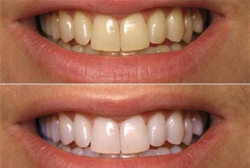 Chỉ cần dùng baking soda theo cách này đảm bảo răng trắng nhanh như sứ