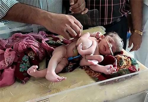 Bé gái sơ sinh có… 4 chân 4 tay ở Ấn Độ