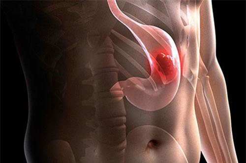 Những yếu tố nguy cơ cao gây ung thư dạ dày