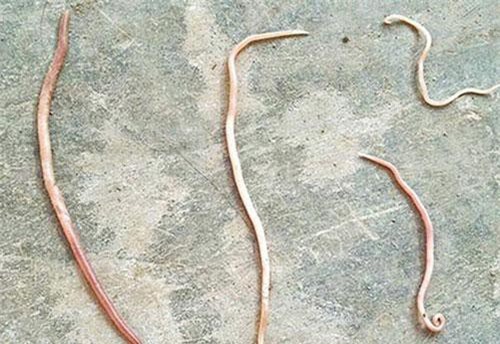 Hãi hùng giun sán bò ra từ... miệng các em nhỏ