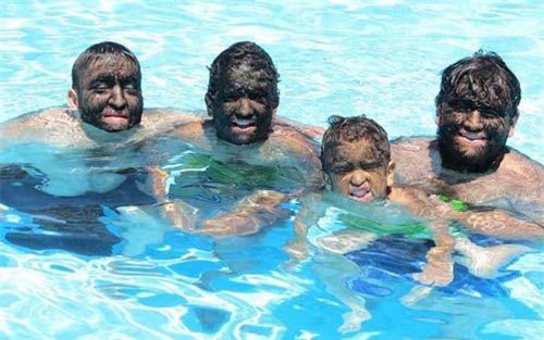 'Người sói' hiện đại và hội chứng kỳ dị nhất hành tinh