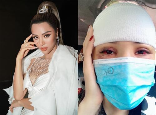 Siêu mẫu Khả Trang gặp tai nạn, bị tụ máu ở mắt và đầu