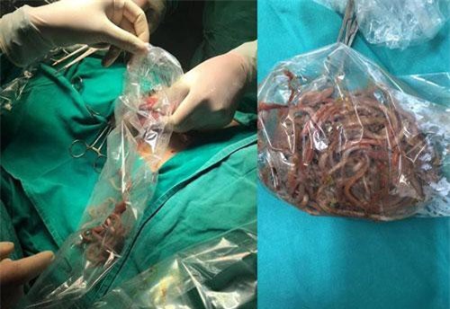 Chăm sóc trẻ thế nào tránh nguy cơ như bệnh nhi mổ búi giun 100 con?