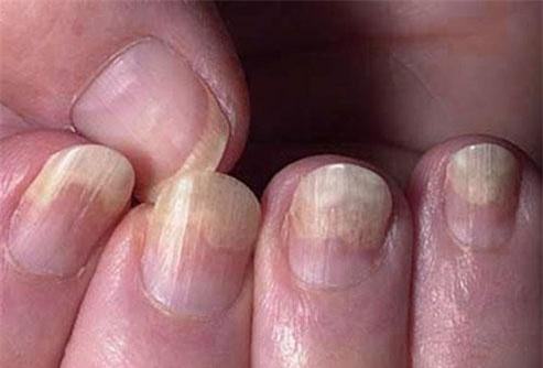 Dấu hiệu bất thường ở móng tay cảnh báo căn bệnh nguy hiểm, nhanh chân đến gặp bác sĩ ngay