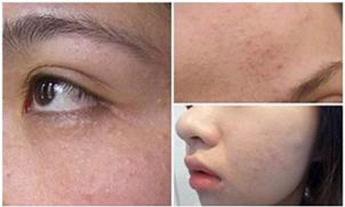 Điểm qua những cách trị mụn trong dân gian có thể bạn chưa biết