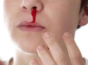 Chảy máu cam: Hãy nhanh chân đến gặp bác sĩ để 'chặn cửa' căn bệnh nguy hiểm