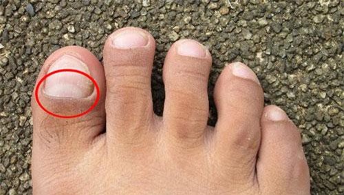 Thấy bàn chân có 'điềm báo' này, hãy cảnh giác vì thận đang gửi lời báo động nhiễm độc nặng