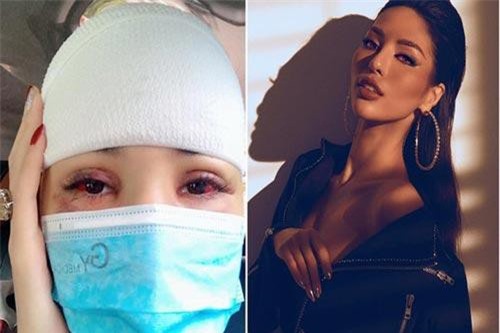 Người mẫu Khả Trang bị tai nạn, tụ máu đầu giờ ra sao?
