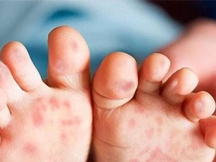 Bệnh tay chân miệng khó phát hiện, dễ bị nhầm với một số bệnh khác