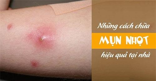 Bí quyết trị mụn nhọt bằng thảo dược tại nhà