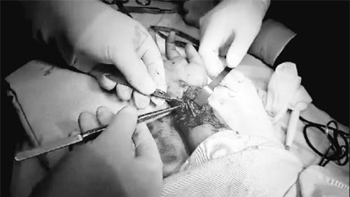 Ngã vào viên gạch vỡ khi đang tắm, bé 6 tuổi bị cứa đứt 7 cọng gân, dây thần kinh trụ