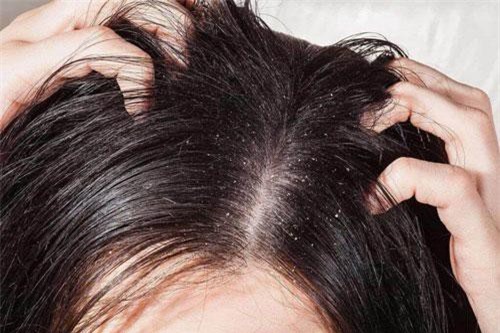 Da đầu khô tróc vảy: Nguyên nhân và cách điều trị giúp da đầu luôn khỏe mạnh