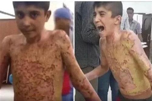 Sát thương kinh hoàng của vũ khí phốt pho Thổ Nhĩ Kỳ