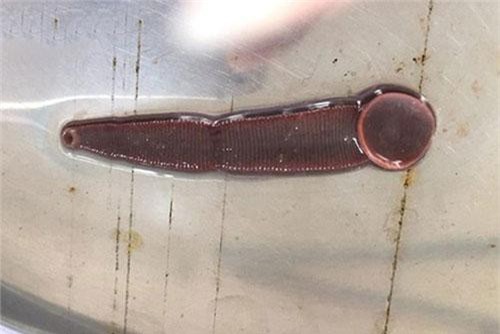 Rùng rợn đỉa ký sinh 3 tháng trong mũi người đàn ông