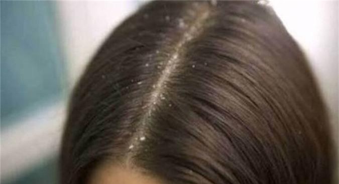 Bỏ túi 8 bí kíp ngăn ngừa gàu hiệu quả trong mùa hanh khô - Hình 6 Bo tui 8 bi kip ngan ngua gau hieu qua trong mua hanh kho-Hinh-6
