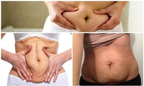 Cách khắc phục da bụng chùng nhão sau sinh cực hiệu quả
