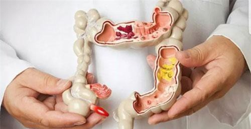 Công nghệ mới phát hiện sớm ung thư đại trực tràng