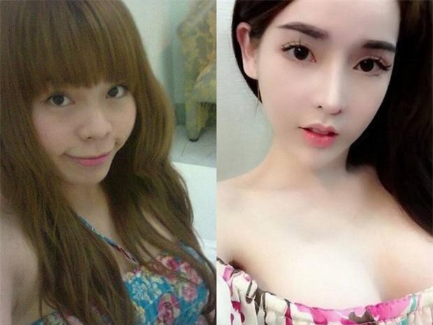 Gô gái 'sống dở chết dở' vì không nhắm được mắt sau dao kéo