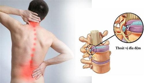 5 bài thuốc dân gian chữa thoát vị đĩa đệm hiệu quả, người bệnh không cần phẫu thuật