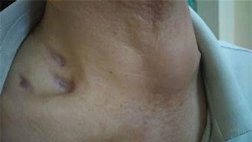 Nổi hạch ở cổ có phải là ung thư?