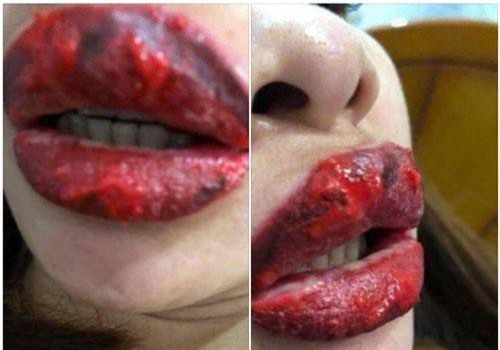 'Hoảng hồn' với những ca biến chứng kinh hoàng vì phun xăm môi hỏng