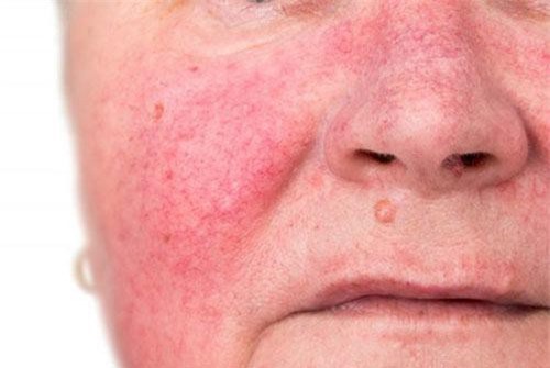 Hoảng hồn những gương mặt biến dạng vì dùng nước lột da tẩy trắng