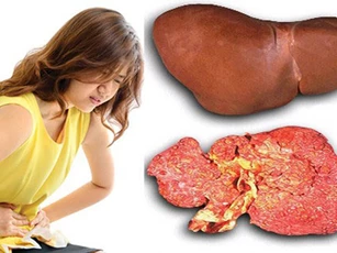 Căn bệnh ung thư đứng đầu Việt Nam: Bất ngờ "thủ phạm" từ người mẹ